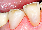 Composite
