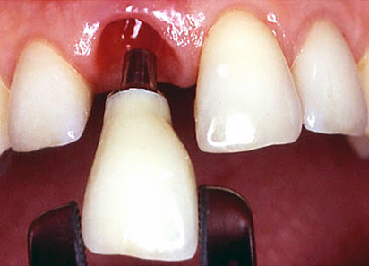 Implantat