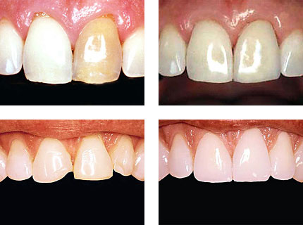 Veneer